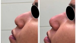 injection acide hyaluronique injections produits comblement paris fillers chirurgie esthetique paris fillers chirurgien esthetique paris dr federico loreto