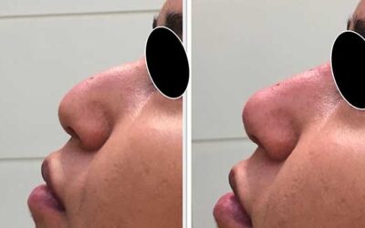 Rhinoplastie médicale
