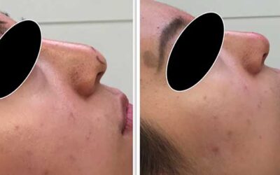 RHINOPLASTIE : NEZ ASIATIQUE OU NOIR