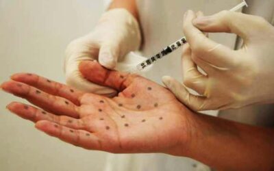 Les injections de toxine botulinique pour la transpiration | botox aisselles