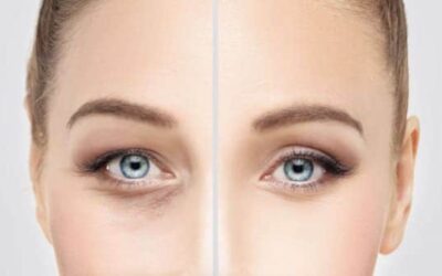 Chirurgie des paupières (ou blépharoplastie) avant après