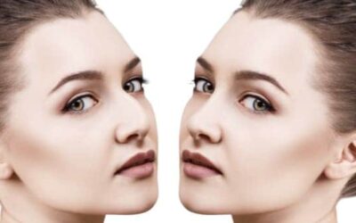 Rhinoplastie médicale : avant après