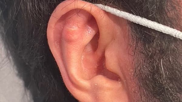 implant earfold non visible earfold paris docteur federico loreto paris chirurgien esthetique visage paris 16