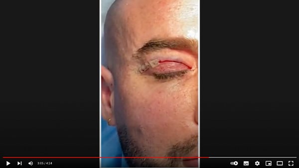 video blepharoplastie paris
