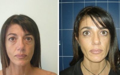 La blépharoplastie chez la femme de 40 ans ?