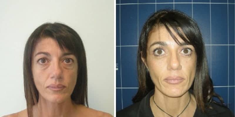 blepharoplastie inferieure jeune operation poche sous les yeux dr loreto federico chirurgien esthetique paris 16