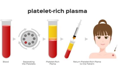 PRP : Platelet Riched Plasma, le plasma enrichi avec les facteurs de croissance des plaquettes