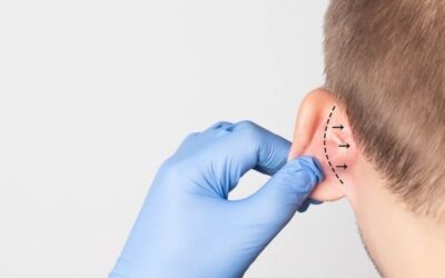 Les résultats après une otoplastie (opération des oreilles) : avant et après