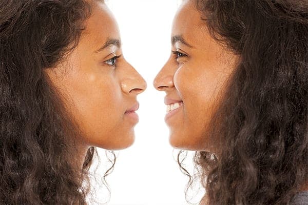 Rhinoplastie ethnique ratée : que faire ?