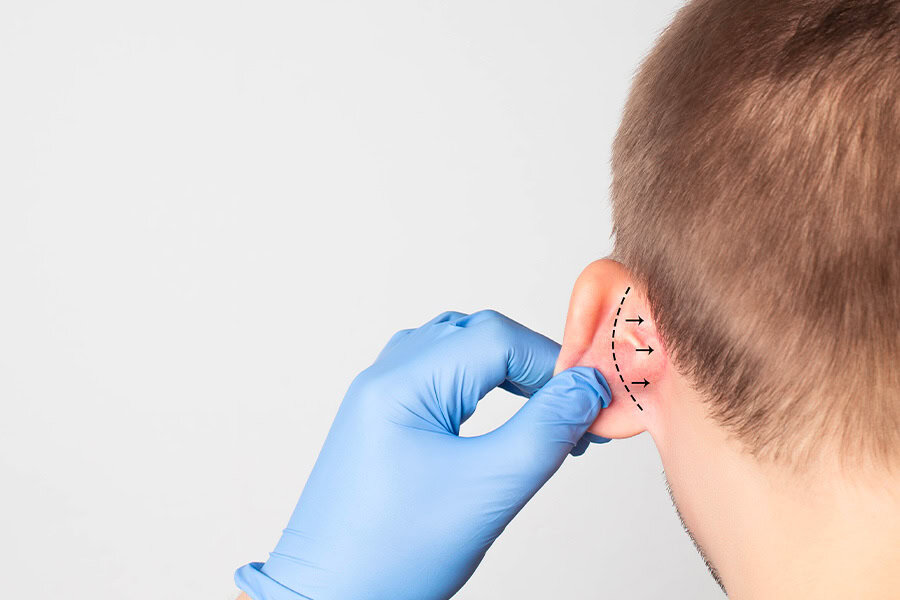 Pourquoi a-t-on une oreille en chou-fleur et quel est son traitement ?