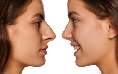 Rhinoplastie pour nez trop long
