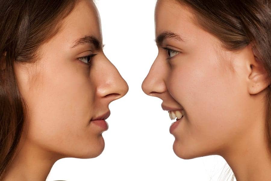 Rhinoplastie pour nez trop long