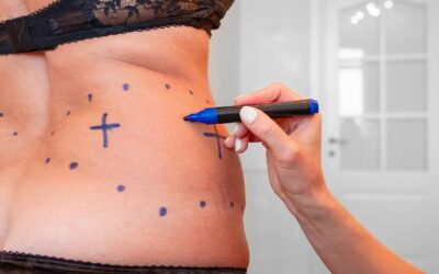Quel est le tarif d’une liposuccion 360 HD (Haute Définition) ?