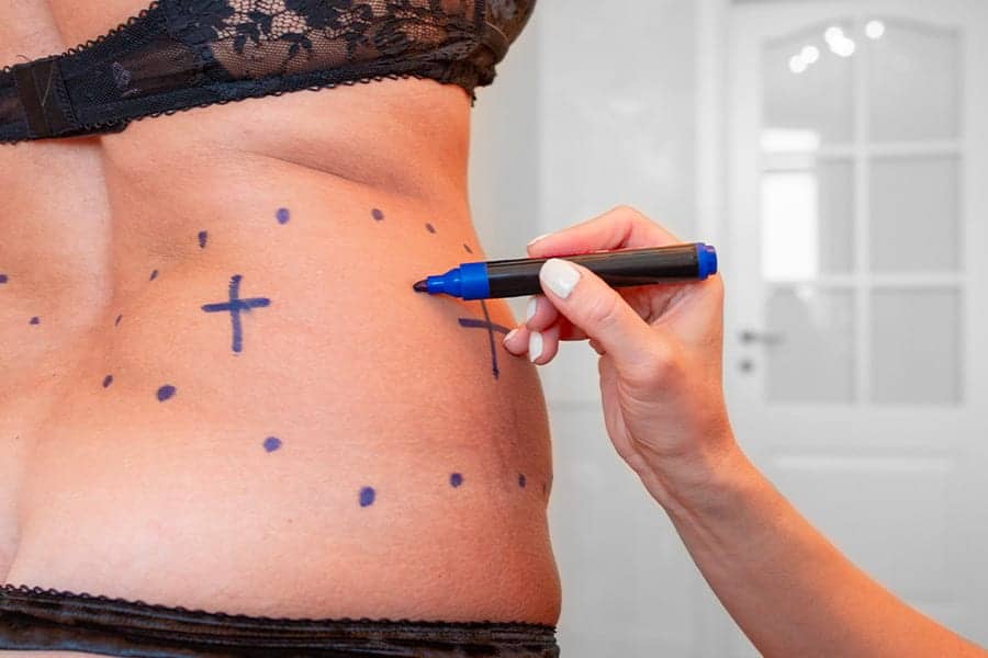 lipo haute definition chirurgie esthetique paris dr federico loreto