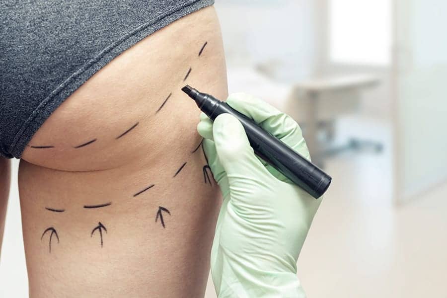 BBL rate que faire de frederico loreto chirurgien plasticien esthetique paris 16