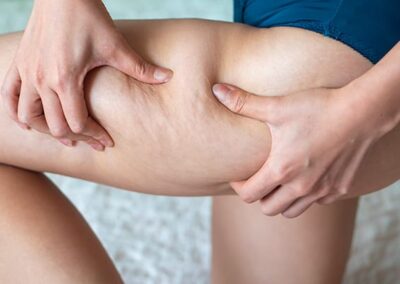 Cellulite des cuisses : causes et traitement envisageable
